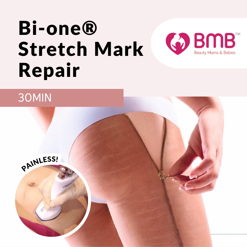 BMB Stretch Mark Repair Trial